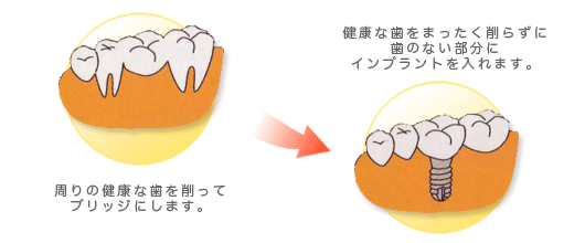 ブリッジ図