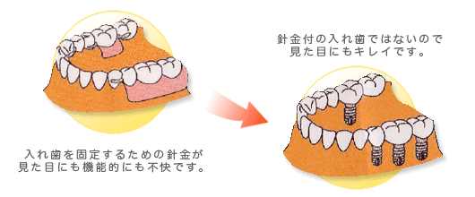 着床タイプ図