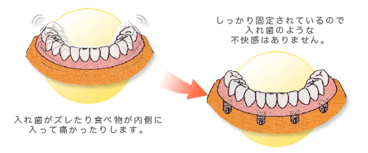 総入れ歯図
